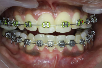 Mid-treatment front photograph