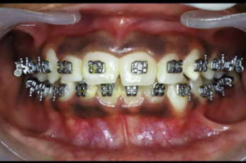 Mid-treatment intraoral photograph