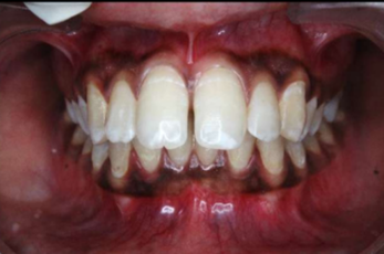 Pre-treatment intraoral photograph