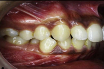 Pre-treatment intraoral photograph