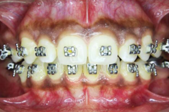 Mid-treatment intraoral photograph