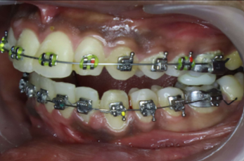 Mid-treatment smile photograph