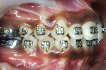 Mid-treatment intraoral photograph