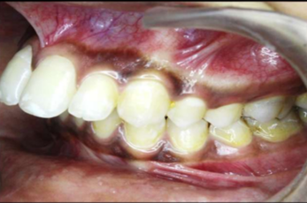 Pre-treatment intraoral photograph