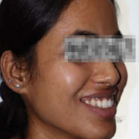 Pre-treatment photograph