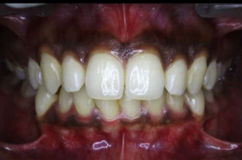 Pre-treatment intraoral photograph
