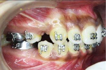 Mid-treatment intraoral photograph