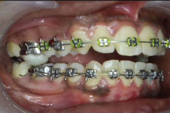 Mid-treatment profile photograph