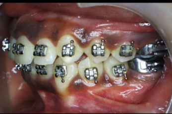 Mid-treatment intraoral photograph