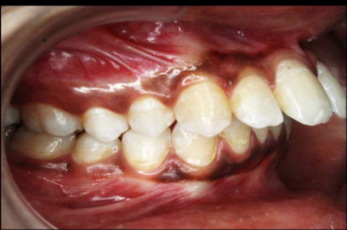 Pre-treatment intraoral photograph