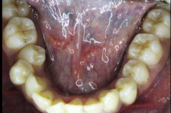 Pre-treatment intraoral photograph