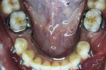 Mid-treatment intraoral photograph