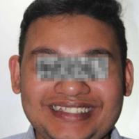 Pre-treatment profile photograph
