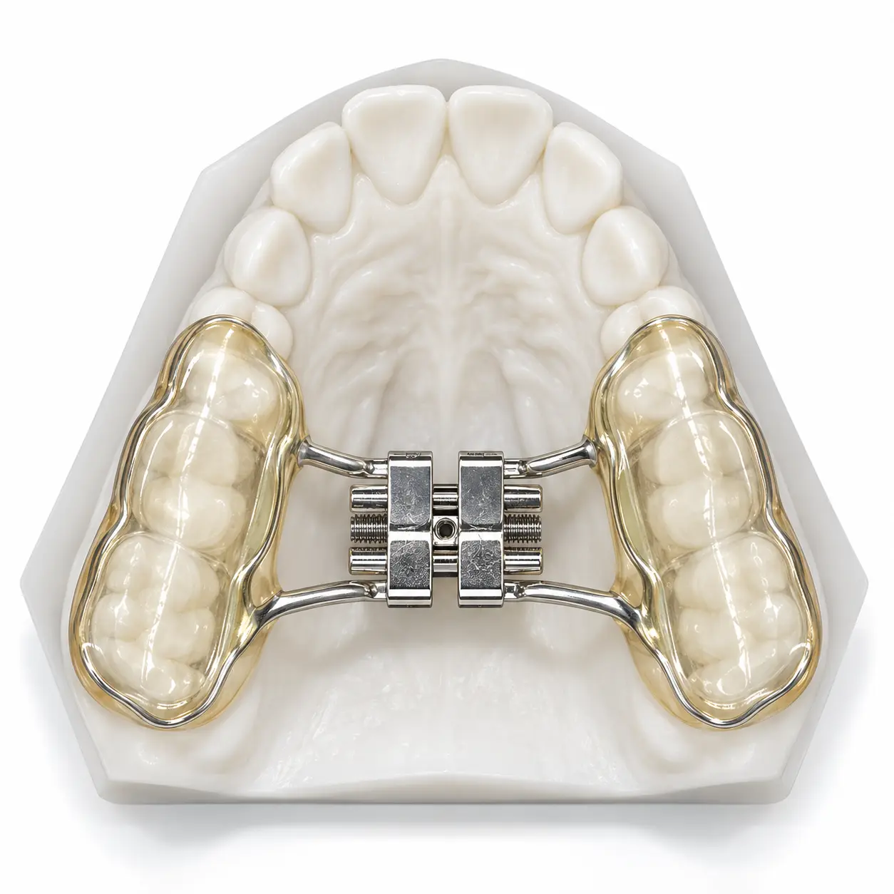 Bondable Hyrax Orthodontic Appliance