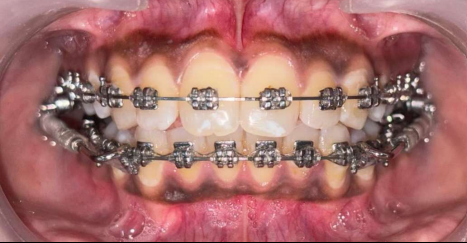 Mid-treatment intraoral photograph