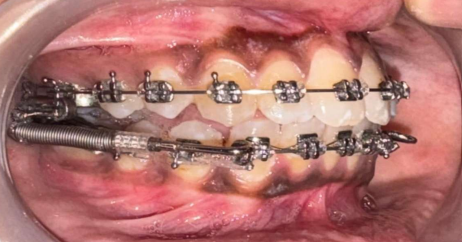 Mid-treatment intraoral photograph