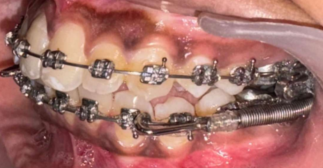 Mid-treatment intraoral photograph
