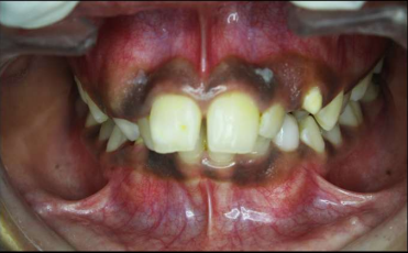 Pre-treatment intraoral photograph