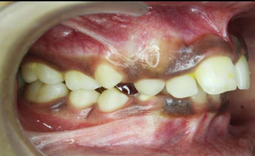 Pre-treatment intraoral photograph