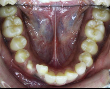 Pre-treatment intraoral photograph
