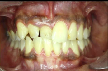 Pre-treatment intraoral photograph
