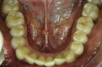 Pre-treatment intraoral photograph