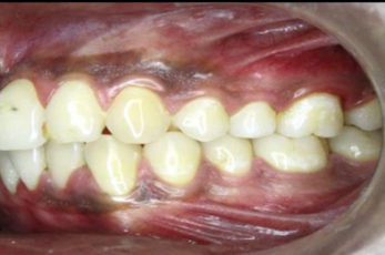 Pre-treatment intraoral photograph